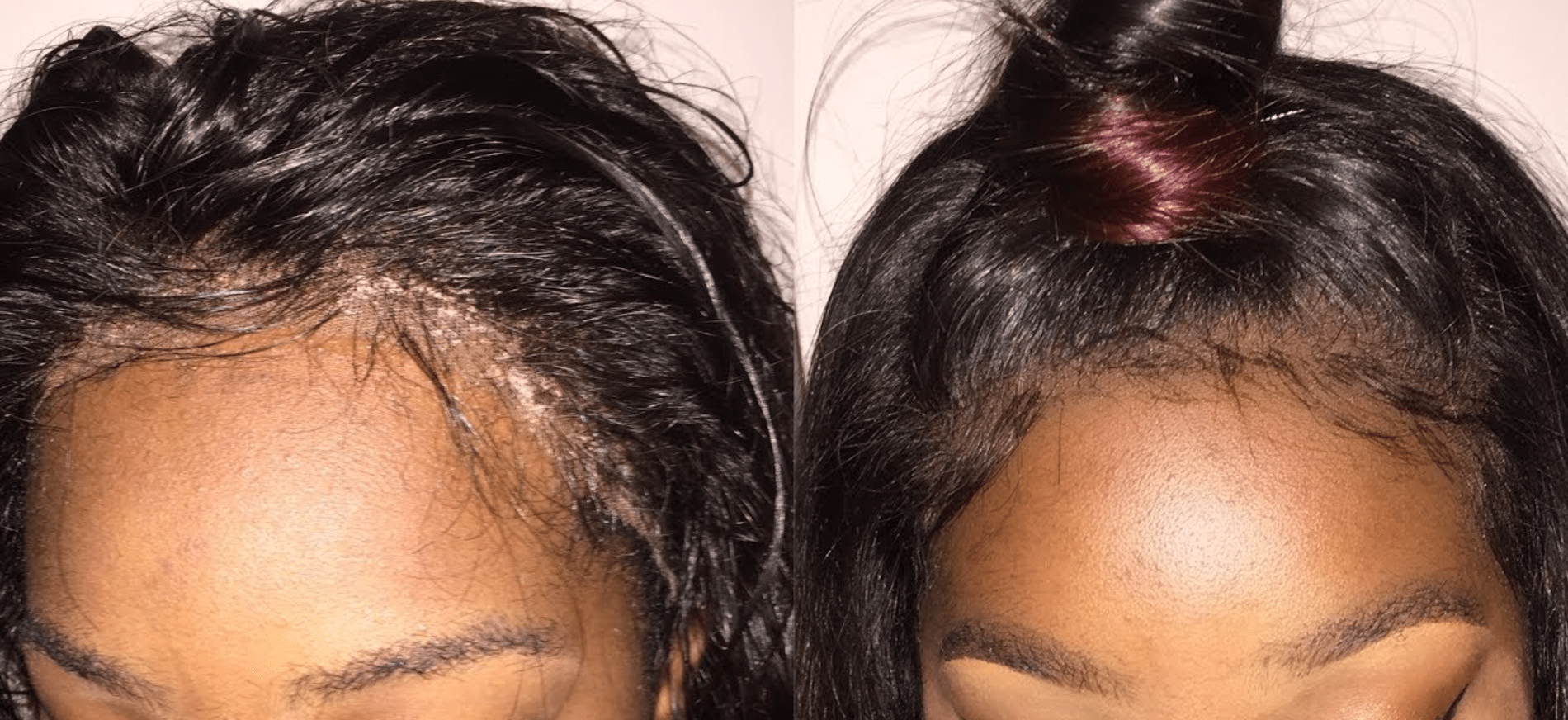 Best Ways to Stop a Lifting Lace Frontal Wig