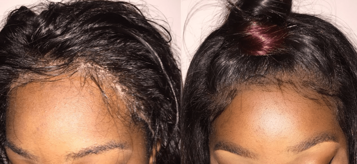 20. Best Ways to Stop a Lifting Lace Frontal Wig